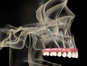 Zygomatic implants skull illustration