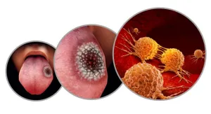Medical illustration showing oral tissue lesion with progressive magnification to microscopic cellular view